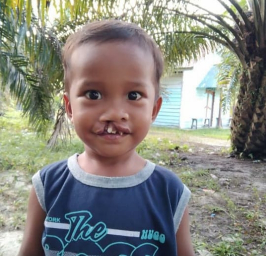 Kepedulian Nyata, Kapolsek IPTU Suheri Sitorus Bantu Fasilitasi Anak Usia Tiga Tahun Operasi Bibir S