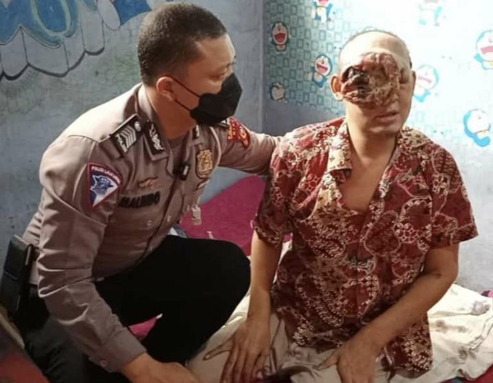 Tumor Ganas Hampir Menutup Semua Wajahnya, Polisi Bantu Carikan Pendonasi